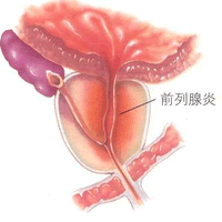 前列腺炎