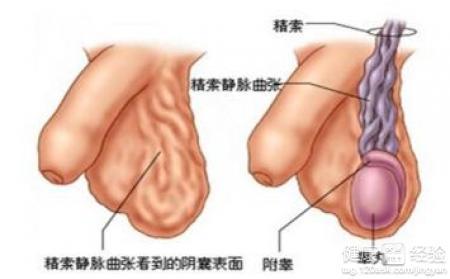 患有睾丸炎要注意以下几点：