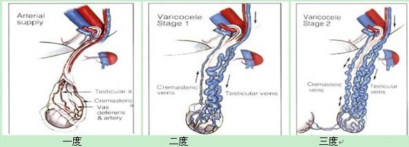 宜春精索静脉曲张是杀死精子的凶手