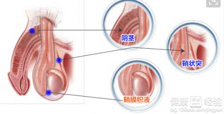 宜春治疗鞘膜积液需要多少钱