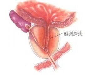 前列腺炎会引起射精无力吗