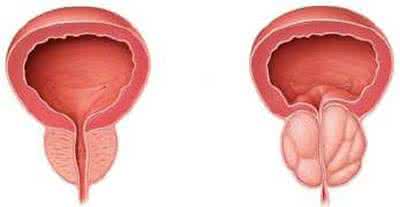 那些常见的前列腺肥大是这样处理的!