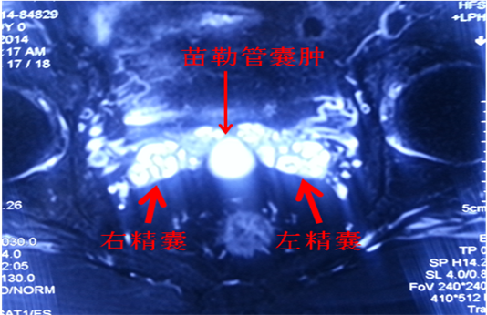 宜春血精如何治疗+右侧精囊结石图