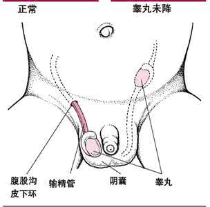 宜春先天性尿道下裂概述-隐睾和腹股沟斜疝