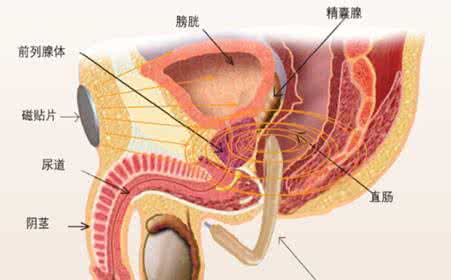 宜春先天性尿道下裂概述-前列腺囊