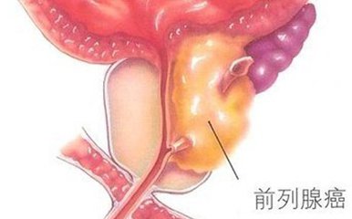 11个危险因素会导致前列腺癌