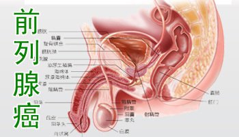 得了前列腺癌可以治疗吗