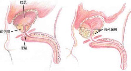 前列腺癌的症状有哪些