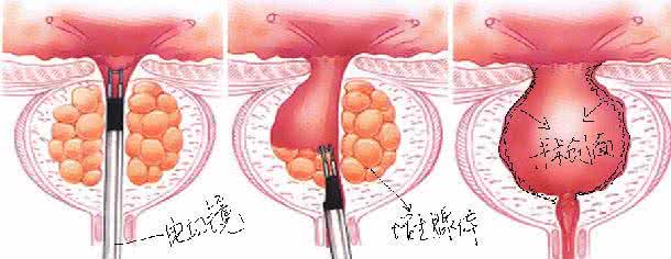 经尿道前列腺电切术