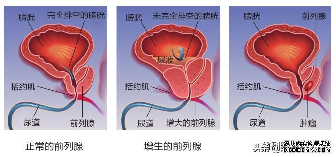 前列腺大就是前列腺增生吗？7个常见误区一次澄清